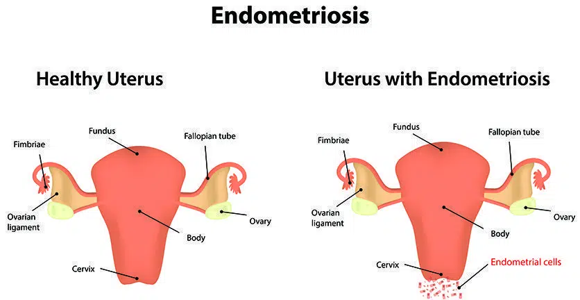 Endometriosis Symptoms, Causes and Treatment