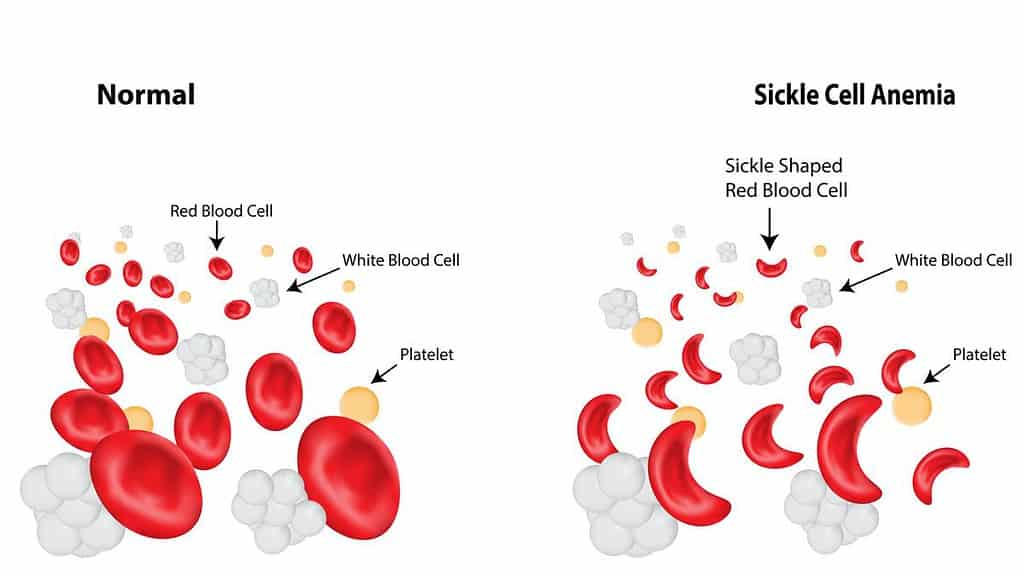Anemia: Symtoms, Type, and Treatment