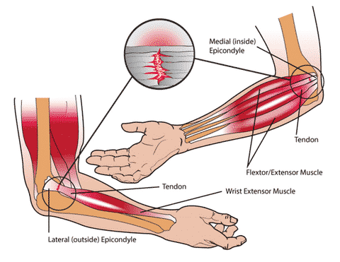 Effective Ways to Reduce Elbow Pain from Tendinitis